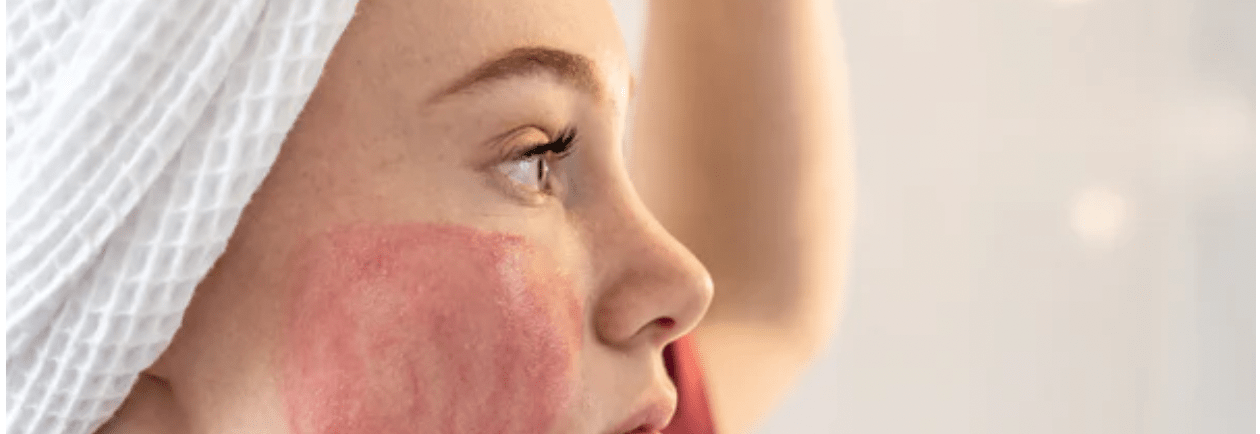 Acné / Peau à tendance acnéique