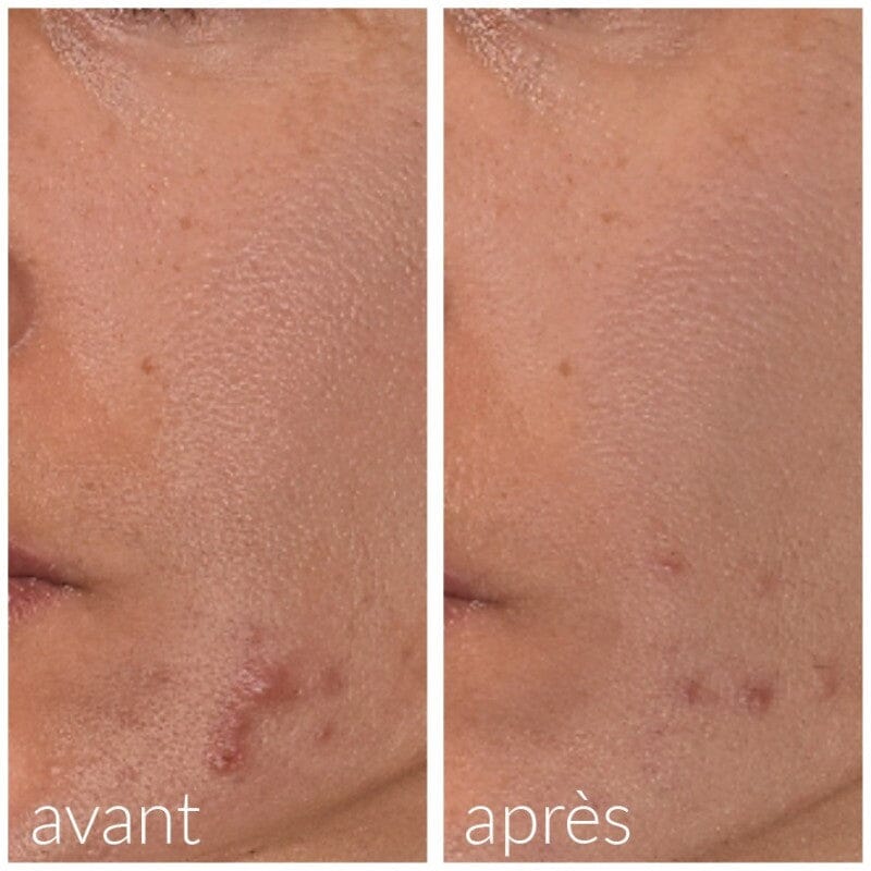 Roller avec serum intégré anti-acné et imperfections Soin Visage Meso'me 