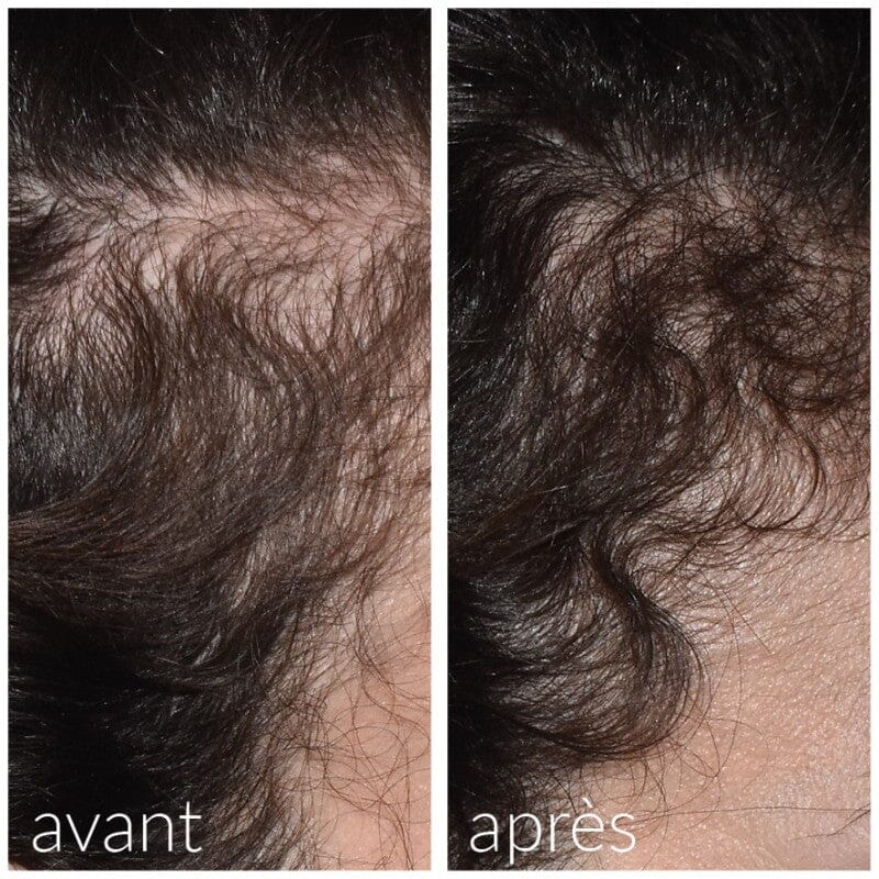 Roller avec sérum intégré redensifiant cheveux Soin Capillaire Meso'me 