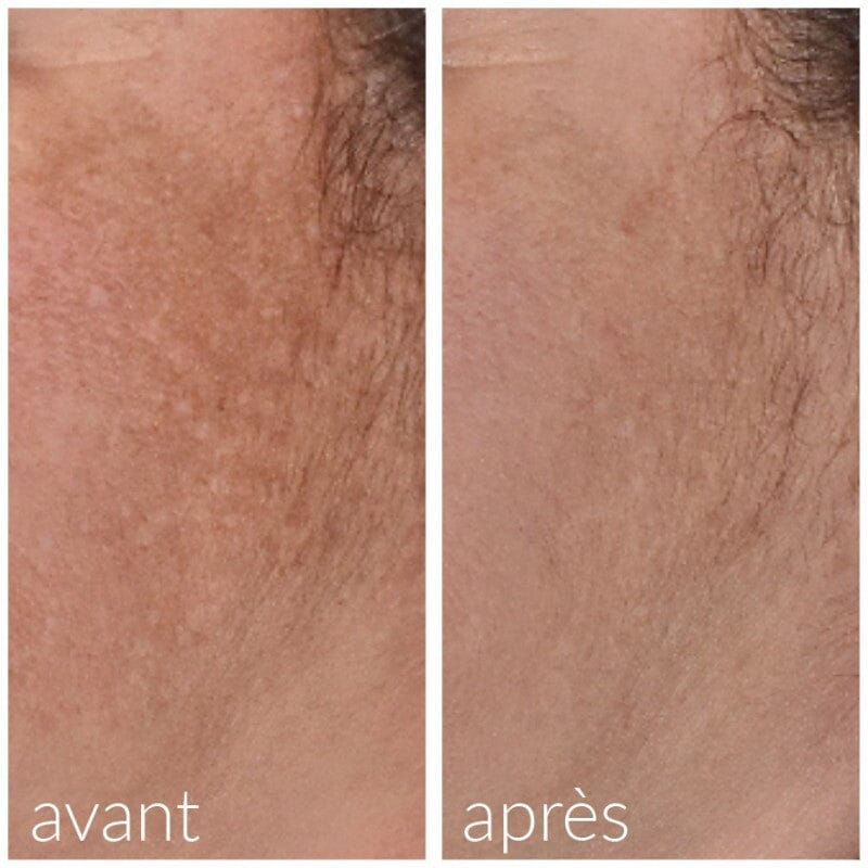 Roller avec serum intégré anti-taches Soin Visage Meso'me 